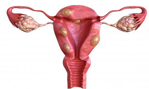 تنبلی تخمدان یکی از شایع ترین بیماریهای زنان